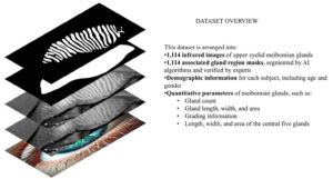 From images to insight: AI builds the first pediatric reference map for meibomian glands